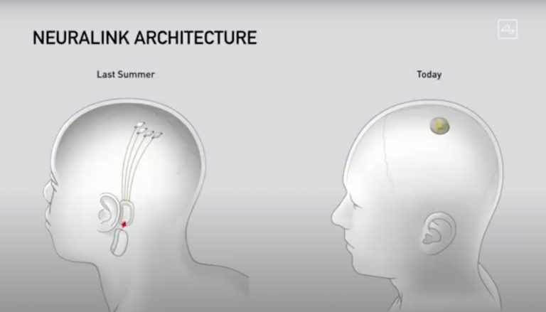 Neuralink Chip Elon Musk